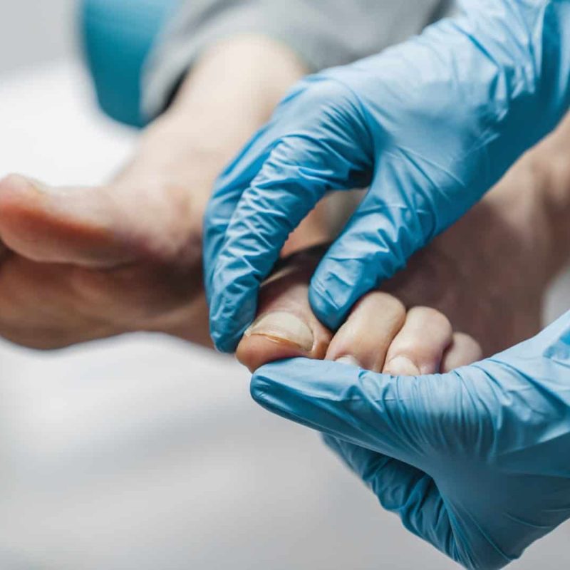 Podiatrist treating feet during procedure